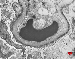 M,58y. | nephrotic syndrome: minimal changes - fusion of pedicles M,58y. | nephrotic syndrome: minimal changes - fusion of pedicles